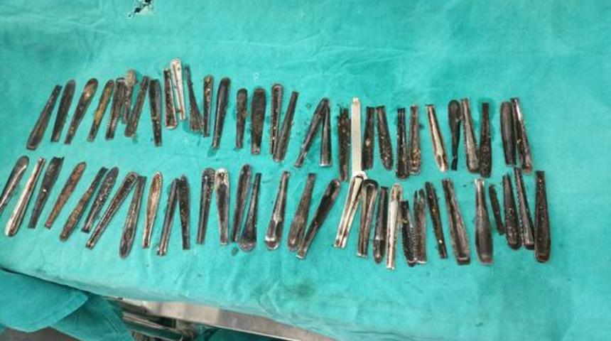 Günlerce yemek yiyemeyen adamın midesinden 63 tane kaşık çıktı! Doktorlar şoke oldu