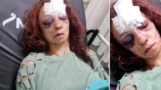 Kıskançlık dehşeti! Erkek arkadaşı tarafından öldüresiye dövüldü, 4 gündür yoğun bakımda