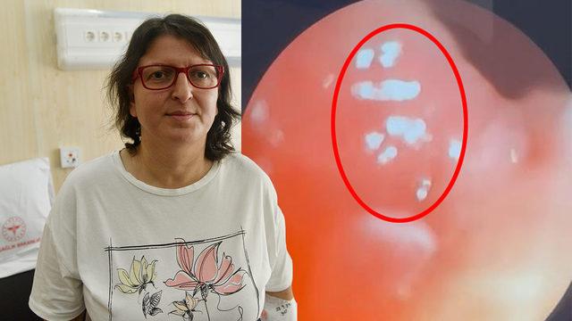 Yanma ve öksürük şikayetiyle hastaneye gitti, hayatının şokunu yaşadı! Nefes borusundan canlı sinek larvaları çıktı
