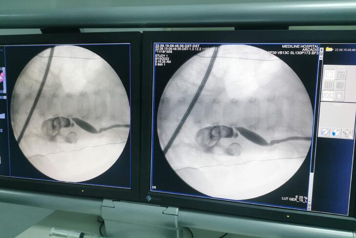 Elazığ'da 13 aylık bebeğin böbreğindeki 5 santimetrelik taş ameliyatla çıkarıldı G4