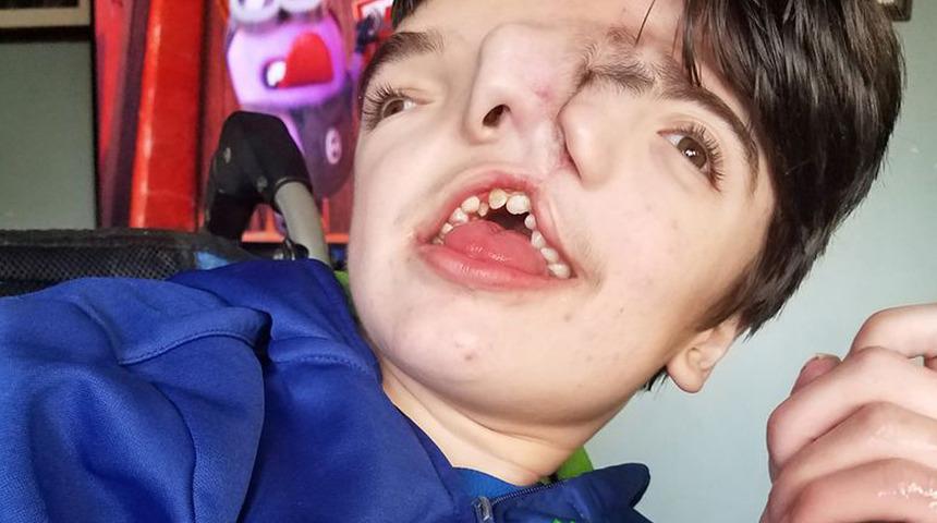 Doktorların 'çok yaşamaz' dediği iki yüzlü doğan çocuk hayata meydan okuyor