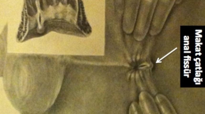 Makatta çatlak – anal fissür nedir?