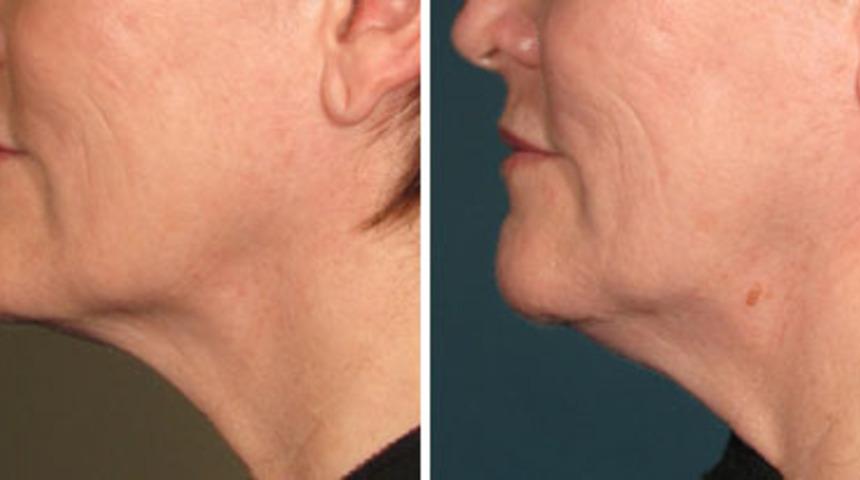 Ameliyatsız Y&uuml;z Germe