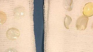 Katarakt ameliyatına gelen hastanın gözünden 27 lens çıktı