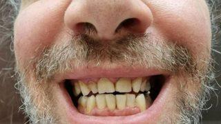 Dişlerini yaptırmak için Türkiye'ye gelen adam büyük hüsran yaşadı! Günlerce çalışamadı