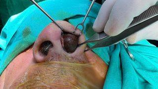 Böylesi görülmedi! 50 yıl boyunca burnunda mermiyle yaşadı