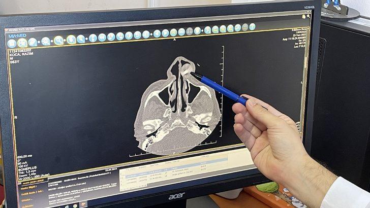 Zonguldak'ta 50 yıldır yüz kemiğinde kurşunla yaşayan hasta ameliyat edildi G2