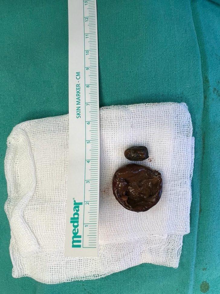 Zonguldak'ta 50 yıldır yüz kemiğinde kurşunla yaşayan hasta ameliyat edildi G5