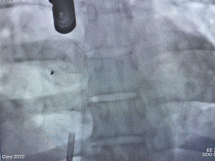 Kalbinde delik olduğunu 58 yaşında öğrenen kadın operasyonla sağlığına kavuştu G4