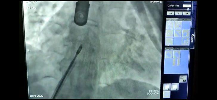 Kalbinde delik olduğunu 58 yaşında öğrenen kadın operasyonla sağlığına kavuştu G5