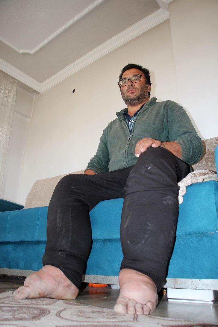 Milyonda bir görülüyor ve tedavisi yok! Ayağı ve bacağı her yıl 7 santim büyüyor G1