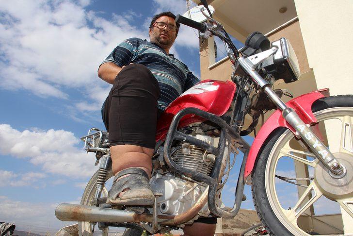 Milyonda bir görülüyor ve tedavisi yok! Ayağı ve bacağı her yıl 7 santim büyüyor G2