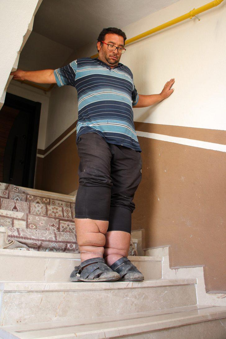 Milyonda bir görülüyor ve tedavisi yok! Ayağı ve bacağı her yıl 7 santim büyüyor G4