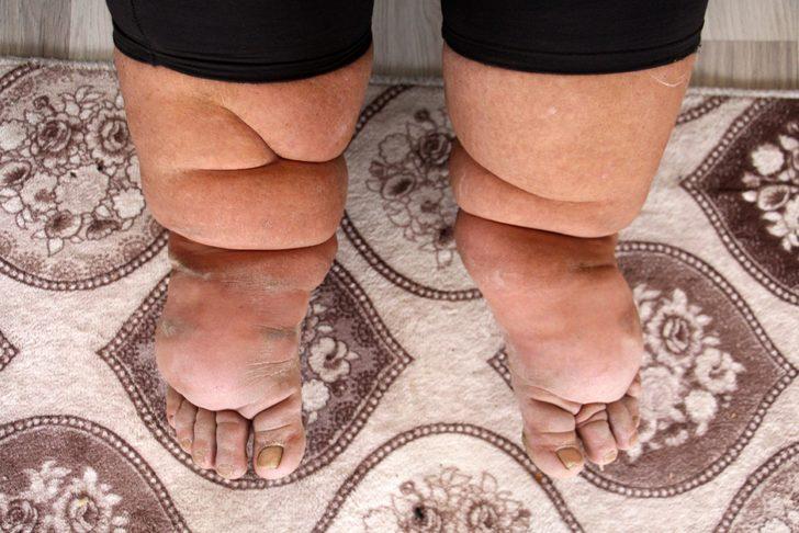 Milyonda bir görülüyor ve tedavisi yok! Ayağı ve bacağı her yıl 7 santim büyüyor G5