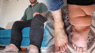 Milyonda bir görülüyor ve tedavisi yok! Ayağı ve bacağı her yıl 7 santim büyüyor