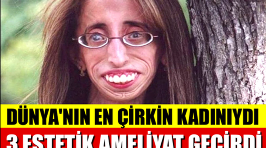 Dünyanın En Çirkin Kadınıydı 3 Estetik Ameliyatı Oldu Şimdi Bakın Ne Halde