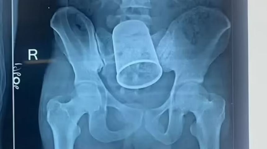 Sarhoşluğun sonucu iyi olmadı! Anüsüne soktuğu madde görenleri şaşırtıyor