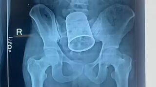 Sarhoşluğun sonucu iyi olmadı! Anüsüne soktuğu madde görenleri şaşırtıyor