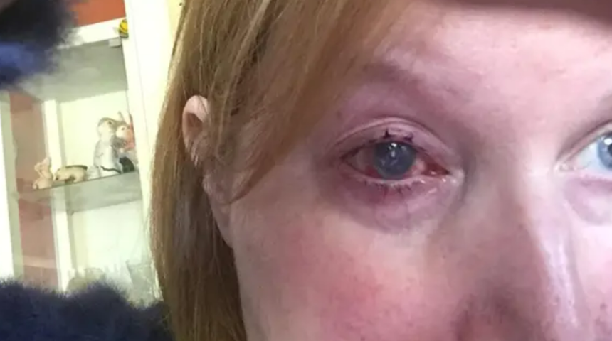 Basit görülen unutkanlık kör kalmasına neden oldu: Lens kullananlar dikkat! 