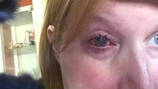 Basit görülen unutkanlık kör kalmasına neden oldu: Lens kullananlar dikkat! 