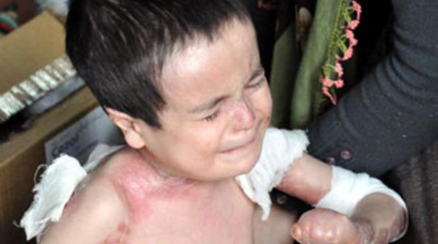 Milyonda bir g&ouml;r&uuml;len hastalık onları buldu