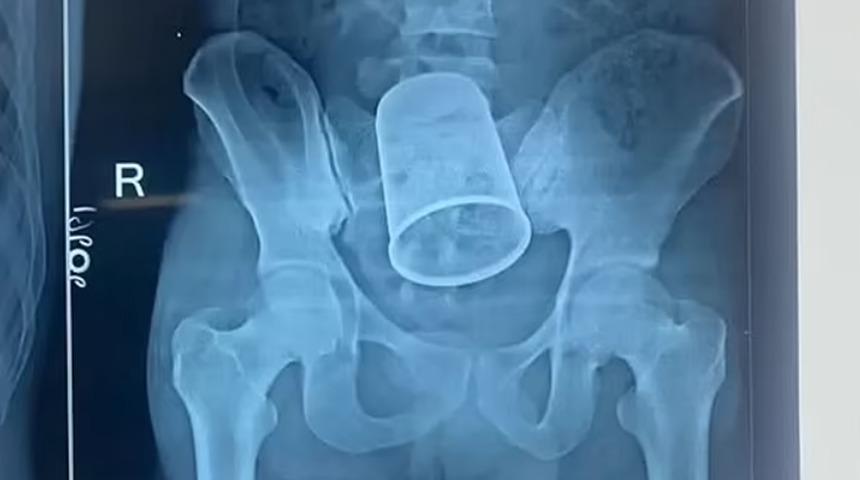 O anları paylaştılar! An&uuml;s&uuml;nden &ccedil;elik bardak &ccedil;ıktı: Bağırsaklarını kestiler! Savunması şaşkınlık yarattı