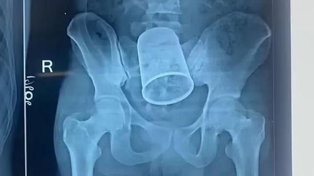 O anları paylaştılar! Anüsünden çelik bardak çıktı: Bağırsaklarını kestiler! Savunması şaşkınlık yarattı