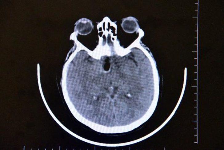 Milyonda bir görülüyordu... 'Felç olabilirsin, ölüm tehlikesi var, kör kalabilirsin' dediler, kimse teşhis koyamadı! Burnundan çıkartıldı G4