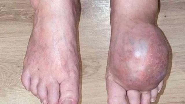 Doktorun korkunç hatası onu bu hale getirdi! Şimdi ölümle karşı karşıya