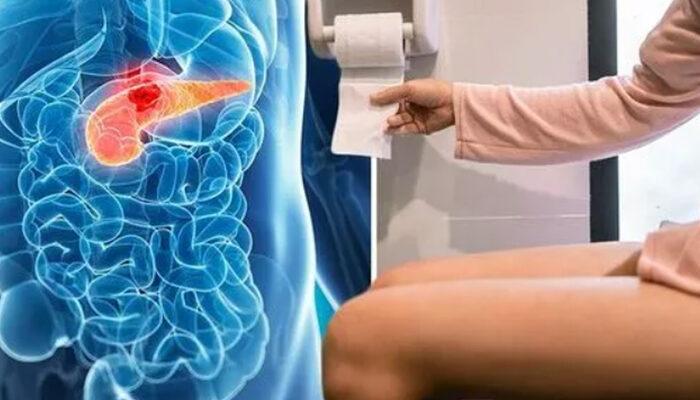 Pankreas kanserinin ilk evredeki en yaygın belirtisi! Tuvaleti mutlaka kontrol edin: Akolik dışkı...