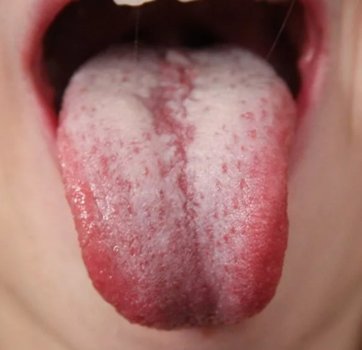 Grip diyerek geçiştiriyorsanız dikkat! Kanserin en önemli belirtisi G5