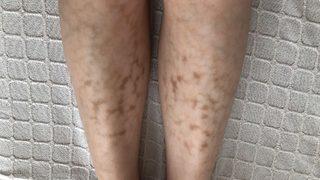 Hastalık ilk kez duyuluyor, yeni yeni vakalar görülüyor! Kaşıntı ve kızarıklıkla ortaya çıkıyor