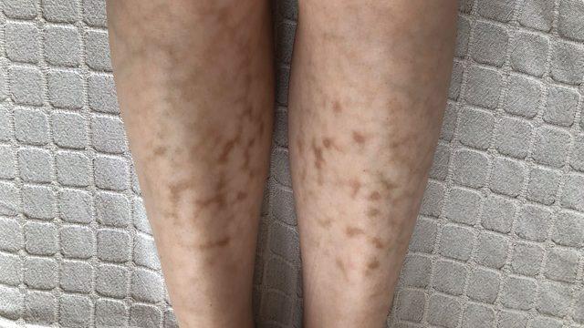 Hastalık ilk kez duyuluyor, yeni yeni vakalar görülüyor! Kaşıntı ve kızarıklıkla ortaya çıkıyor