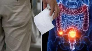 Bağırsak kanserinin ilk belirtisi: Hematokezya! Tuvaletten çıkmadan önce mutlaka kontrol edin