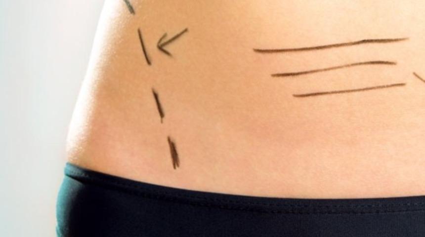 Karın germe ameliyatında dikkat edilecekler nelerdir?