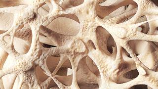 Kemikleri içten içe çürütüyor, kıl gibi inceltiyor, kırılmasına neden oluyor!