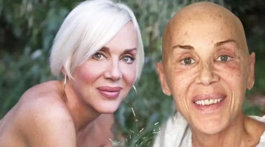 Billur Kalkavan'ın ölüm nedeni olan akciğer kanseri belirtileri nelerdir? Akciğer kanseri yaşam süresi ne ve tedavisi nasıl yapılır? Billur Kalkavan'dan acı haber!