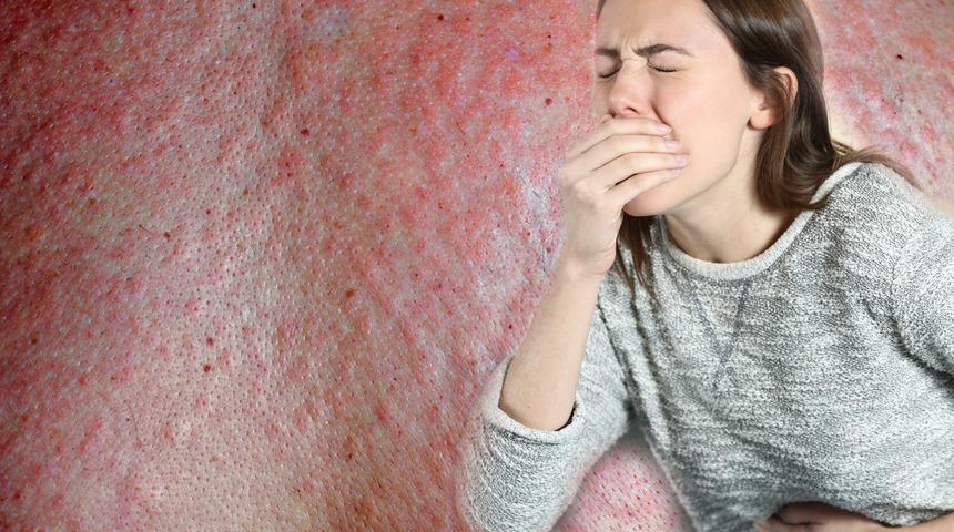 Diliniz şişer, kusmaya ve kurdeşen dökmeye başlarsınız: Hayatınız tehlike altında olabilir! Alerjiniz olduğunu nasıl anlarsınız?