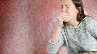 Diliniz şişer, kusmaya ve kurdeşen dökmeye başlarsınız: Hayatınız tehlike altında olabilir! Alerjiniz olduğunu nasıl anlarsınız?