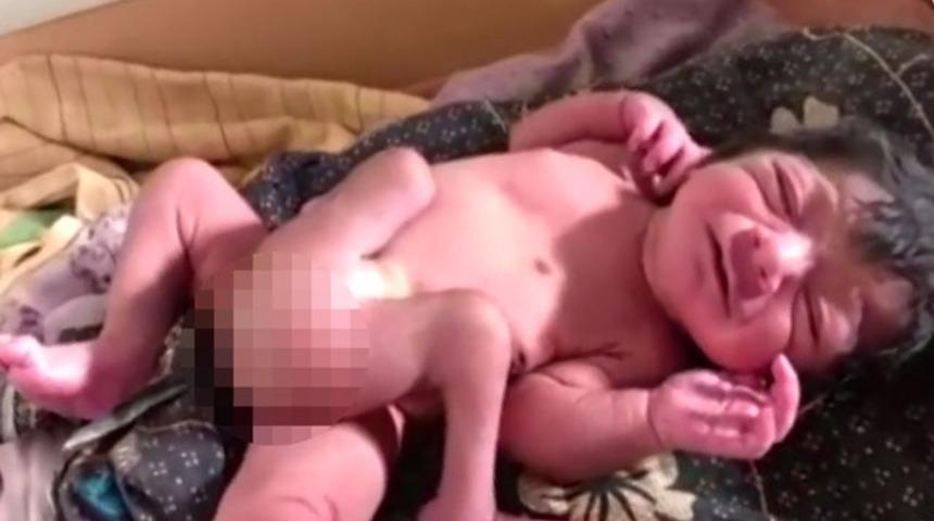 Hindistan'da d&ouml;rt bacaklı, iki penisli bebek doğdu!