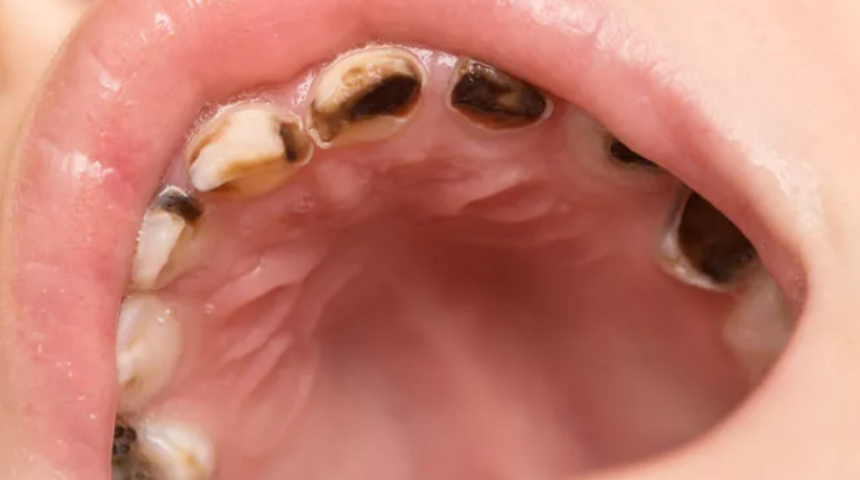 Ağız kokusunu önemsiz görmeyin! Tedavi edilmezse dişlerinizi teker teker kaybedersiniz