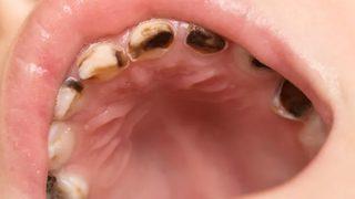 Ağız kokusunu önemsiz görmeyin! Tedavi edilmezse dişlerinizi teker teker kaybedersiniz