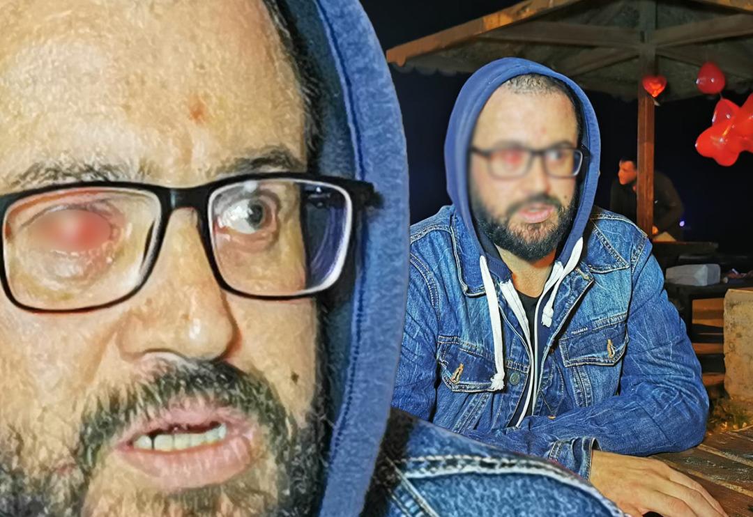 Samsun'da diş teknisyeni sol g&ouml;z&uuml;n&uuml; kaybetti! 'Bu olay benim hayatımı bitirdi'