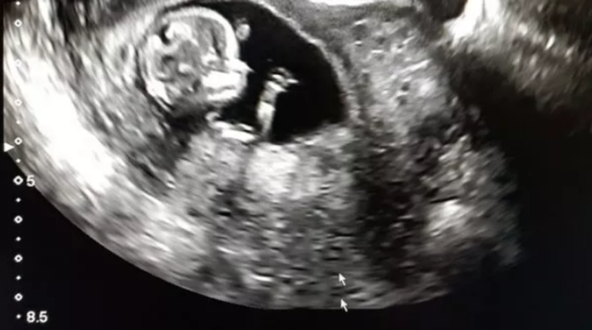 Duyanlar şaşırıyor: 30 milyonda bir görülüyor! Cinsel organı olmadan doğdu...