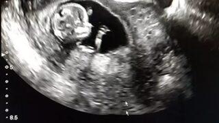 Duyanlar şaşırıyor: 30 milyonda bir görülüyor! Cinsel organı olmadan doğdu...