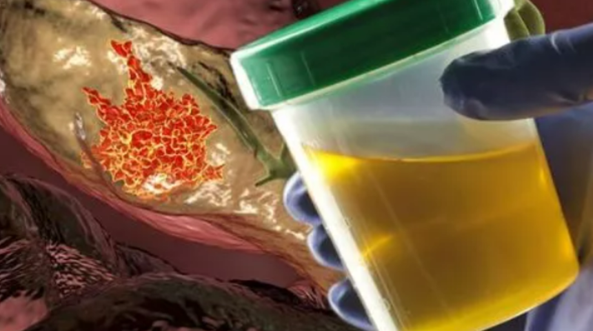 Önemsiz görmeyin! Pankreas kanserinin ilk belirtisi bu şekilde görülüyor