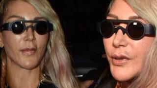 Hande Yener'den şaşkına çeviren estetik itirafı! Morlukları dikkat çekti