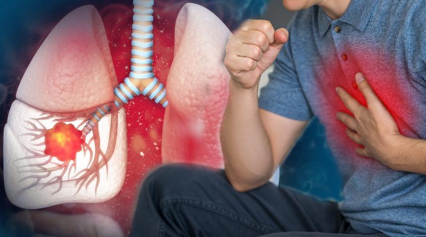Akciğer kanserinin en sık görülen belirtisi: Hemoptizi!