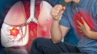 Akciğer kanserinin en sık görülen belirtisi: Hemoptizi!