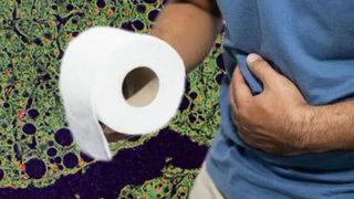 İlk zamanlarda zararsızdır; tedavi edilmezse... Melena’yı fark ettiğiniz an harekete geçin 